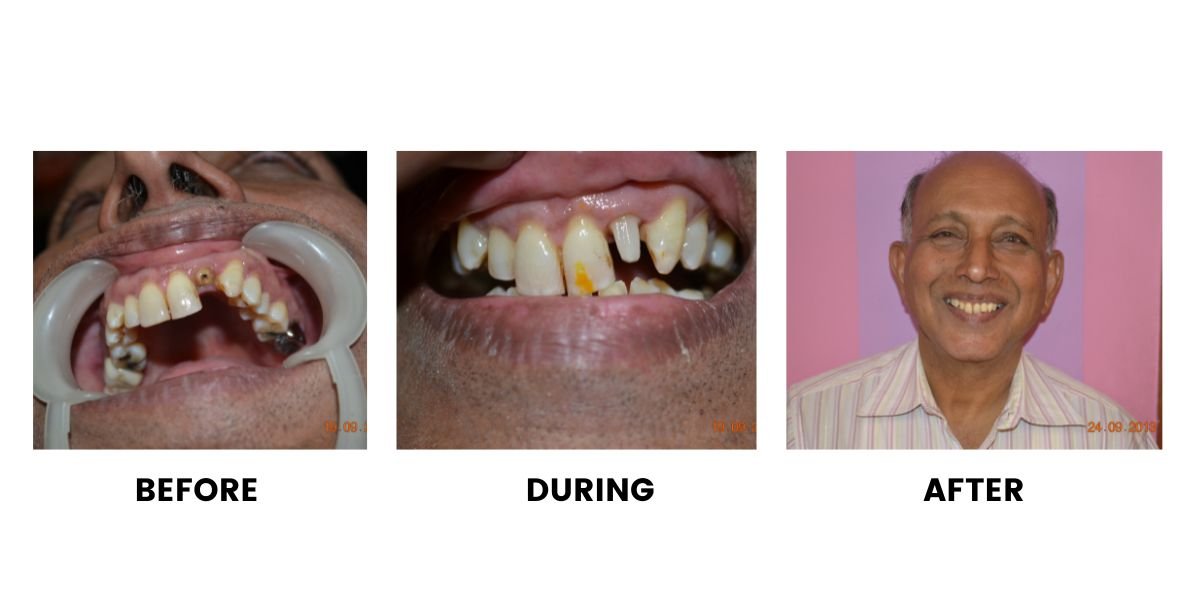 Before and after dental treatment: plate 13 of 38 from the practice’s own record, the patient before treatment on the left and after treatment on the right.