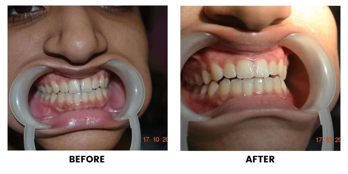 Before and after dental treatment: plate 17 of 38 from the practice’s own record, the patient before treatment on the left and after treatment on the right.