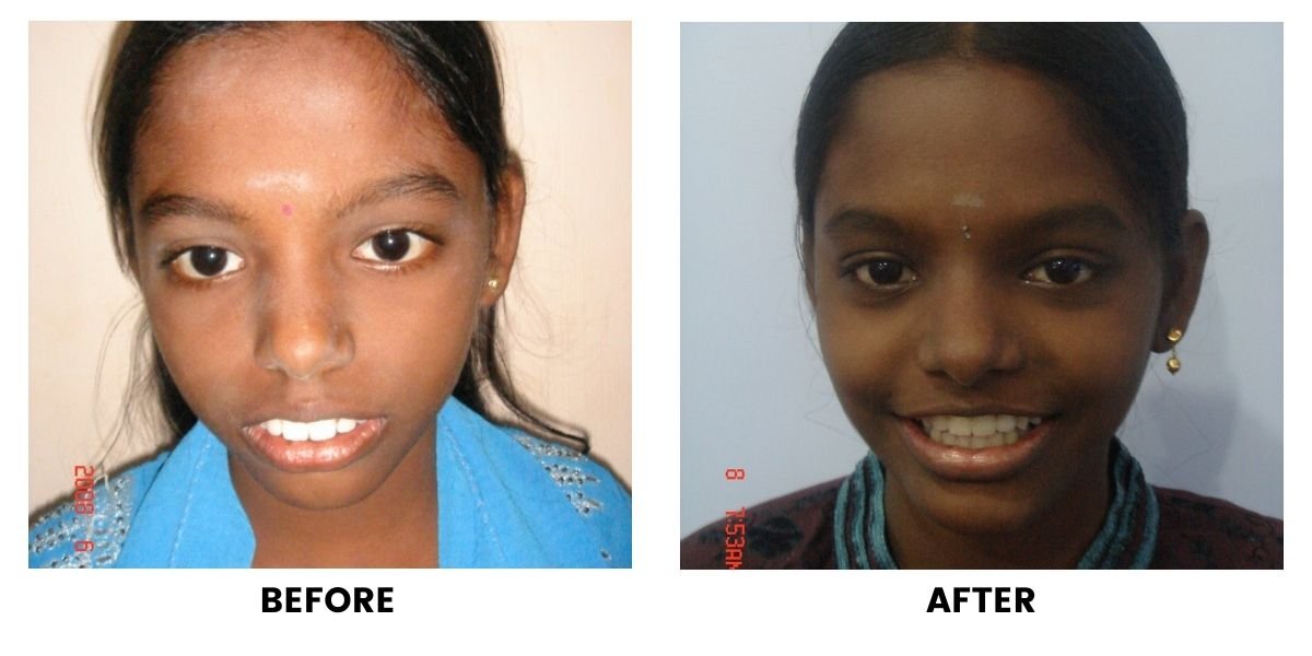 Before and after dental treatment: plate 33 of 38 from the practice’s own record, the patient before treatment on the left and after treatment on the right.