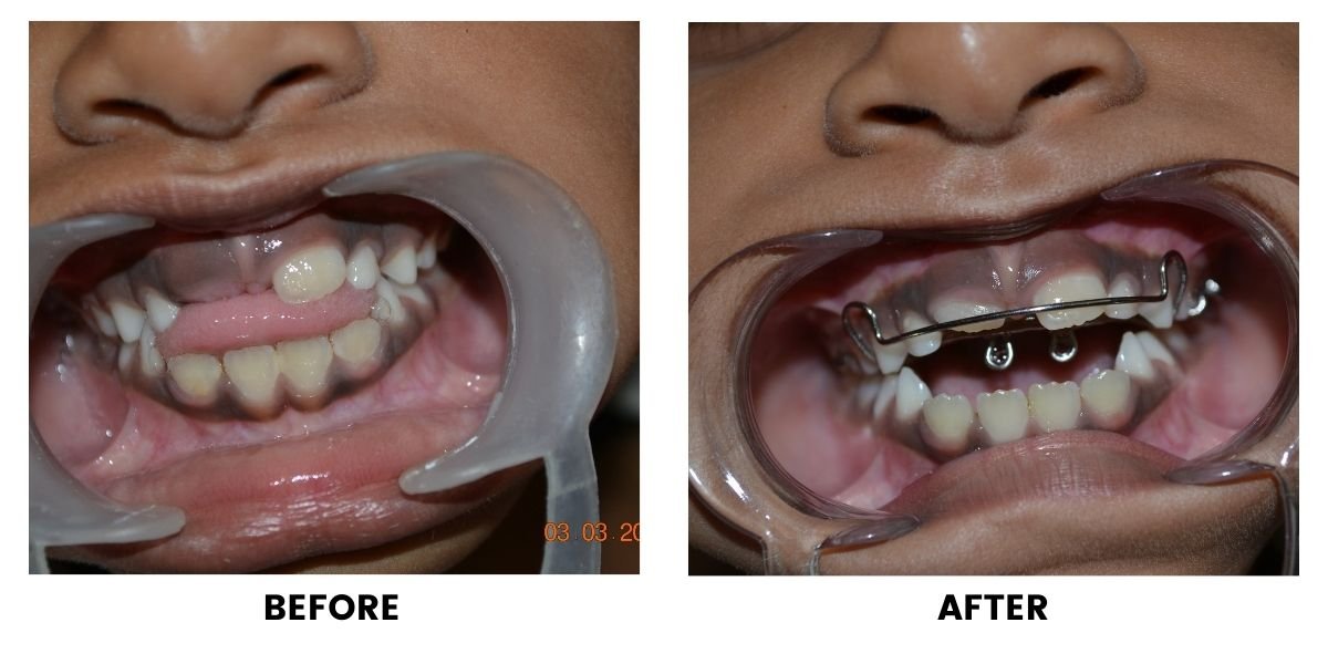 Before and after treatment of a child: plate 1 of 5 from the practice’s own record, the patient before treatment on the left and after treatment on the right.