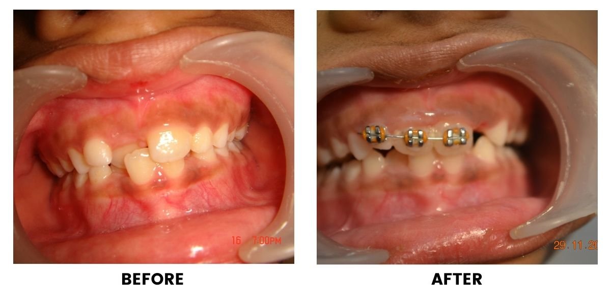 Before and after treatment of a child: plate 2 of 5 from the practice’s own record, the patient before treatment on the left and after treatment on the right.