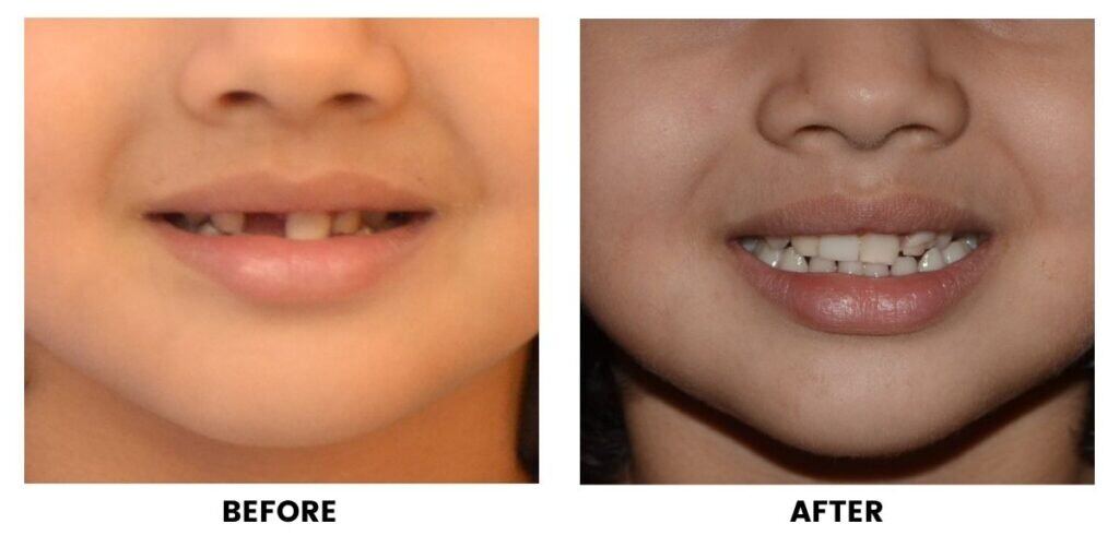 Before and after treatment of a child: plate 3 of 5 from the practice’s own record, the patient before treatment on the left and after treatment on the right.