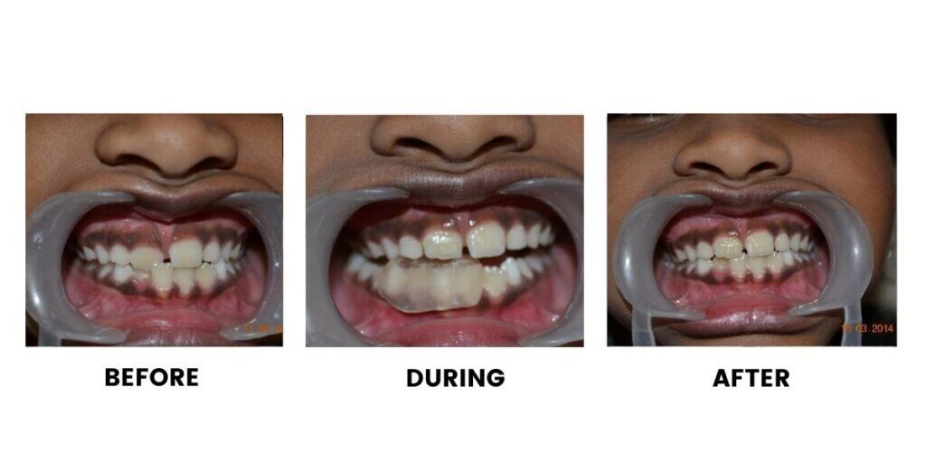 Before and after treatment of a child: plate 4 of 5 from the practice’s own record, the patient before treatment on the left and after treatment on the right.