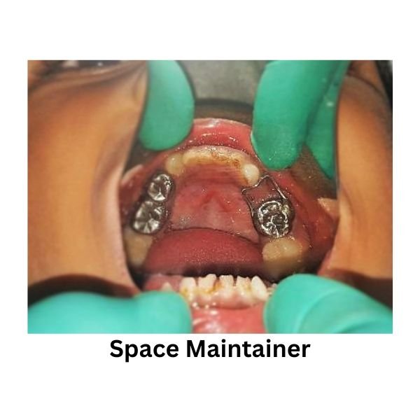 A space maintainer fitted in a child’s mouth, holding the gap open until the adult tooth arrives.