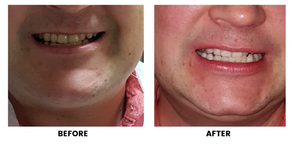 Before and after gum treatment: plate 3 of 4 from the practice’s own record, the patient before treatment on the left and after treatment on the right.
