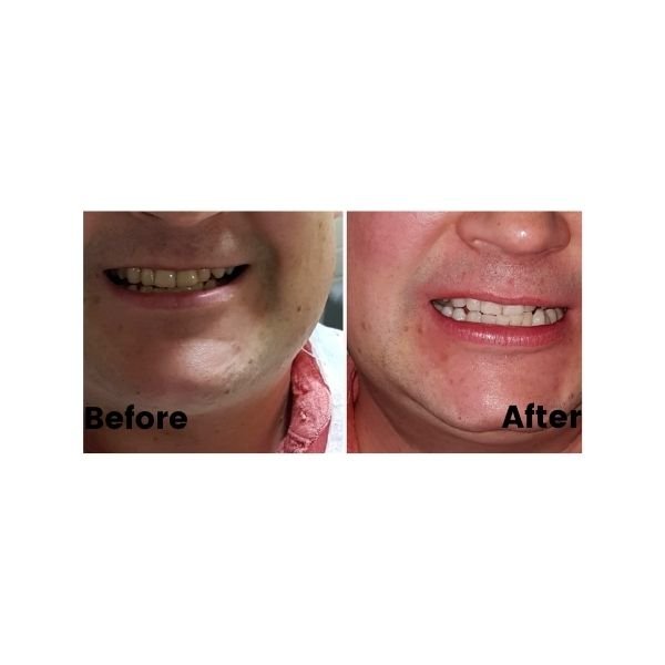 Before and after gum treatment: plate 4 of 4 from the practice’s own record, the patient before treatment on the left and after treatment on the right.