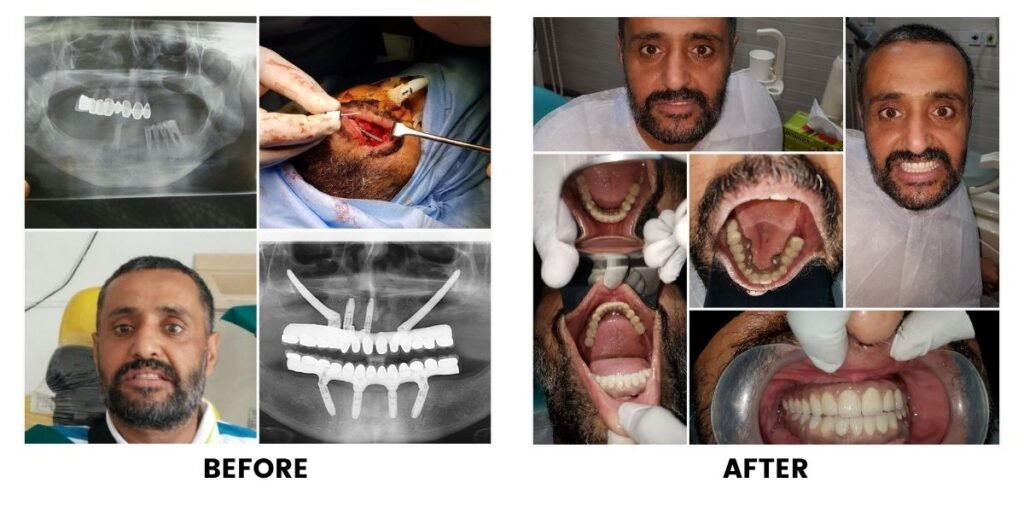 A full-mouth implant case shown as a panel of photographs and radiographs, the mouth before treatment on the left and the finished teeth on the right.