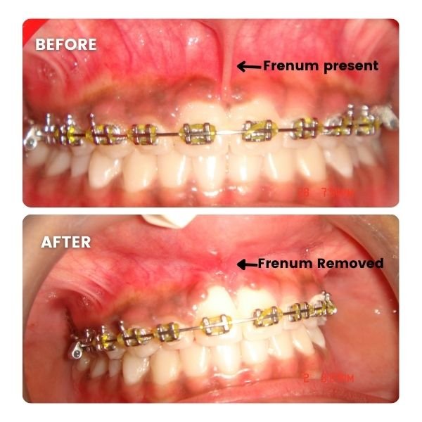 Before and after a laser frenectomy: the frenum in place in the upper photograph and removed in the lower one, with the braces in position in both.
