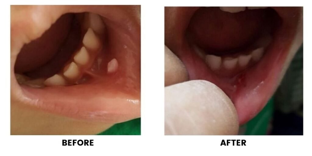 Before and after laser treatment of the gums: tissue overgrown across the lower teeth on the left, and reshaped on the right.