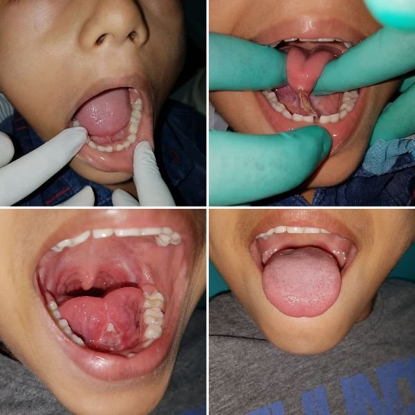 Four views of a laser tongue-tie release, the restricted tongue before the procedure and the freed tongue after it.