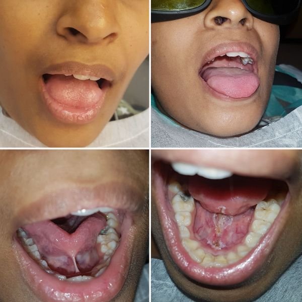 Four views of a laser tongue-tie release in a younger patient, before the procedure and after it.