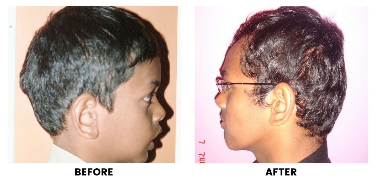 Before and after orthodontic treatment: plate 2 of 53 from the practice’s own record, the patient before treatment on the left and after treatment on the right.