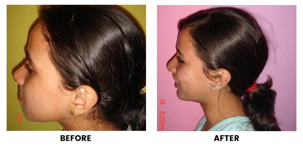 Before and after orthodontic treatment: plate 3 of 53 from the practice’s own record, the patient before treatment on the left and after treatment on the right.