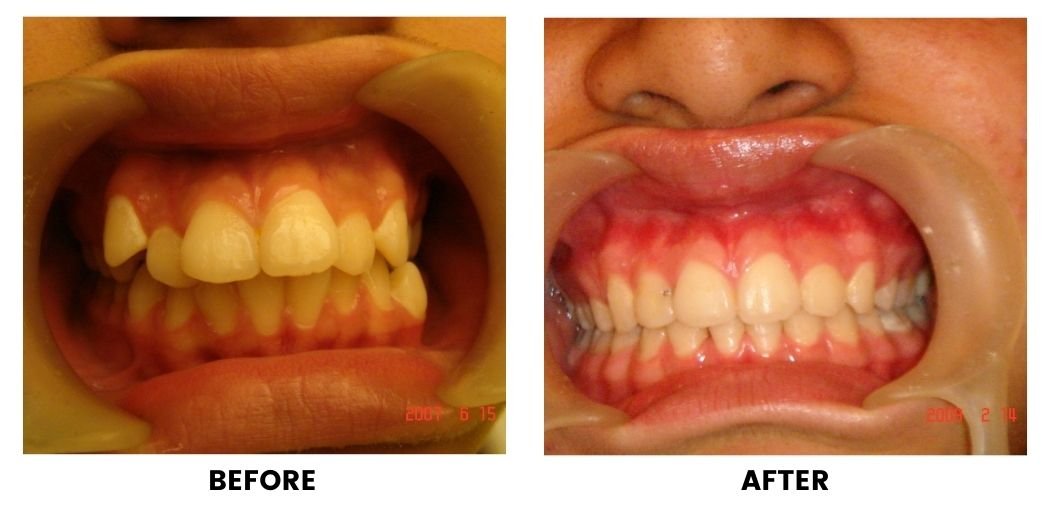 Before and after orthodontic treatment: plate 4 of 53 from the practice’s own record, the patient before treatment on the left and after treatment on the right.