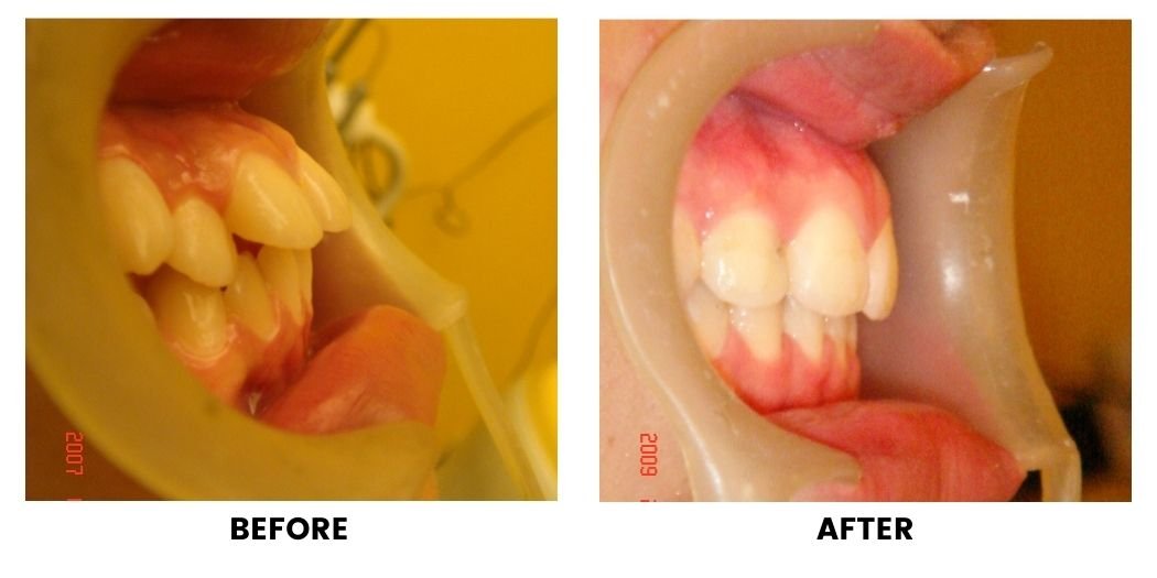 Before and after orthodontic treatment: plate 5 of 53 from the practice’s own record, the patient before treatment on the left and after treatment on the right.
