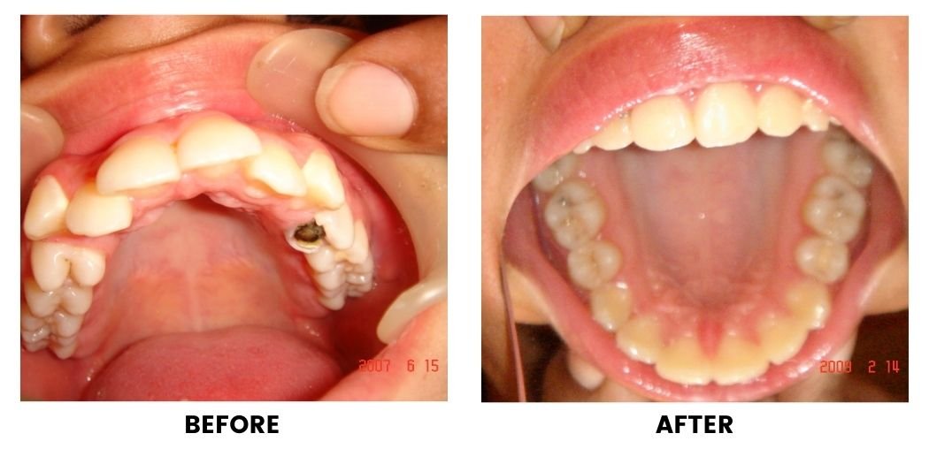 Before and after orthodontic treatment: plate 6 of 53 from the practice’s own record, the patient before treatment on the left and after treatment on the right.