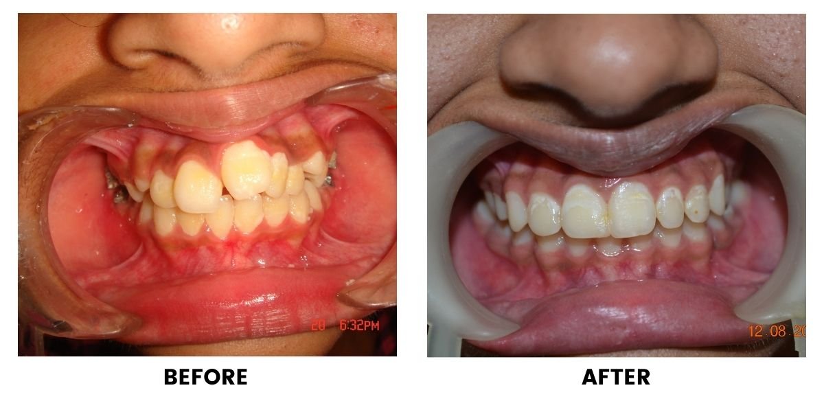 Before and after orthodontic treatment: plate 11 of 53 from the practice’s own record, the patient before treatment on the left and after treatment on the right.