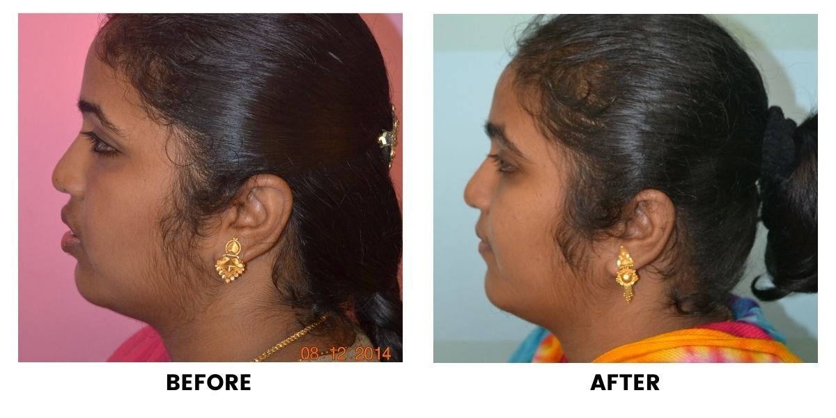 Before and after orthodontic treatment: plate 13 of 53 from the practice’s own record, the patient before treatment on the left and after treatment on the right.