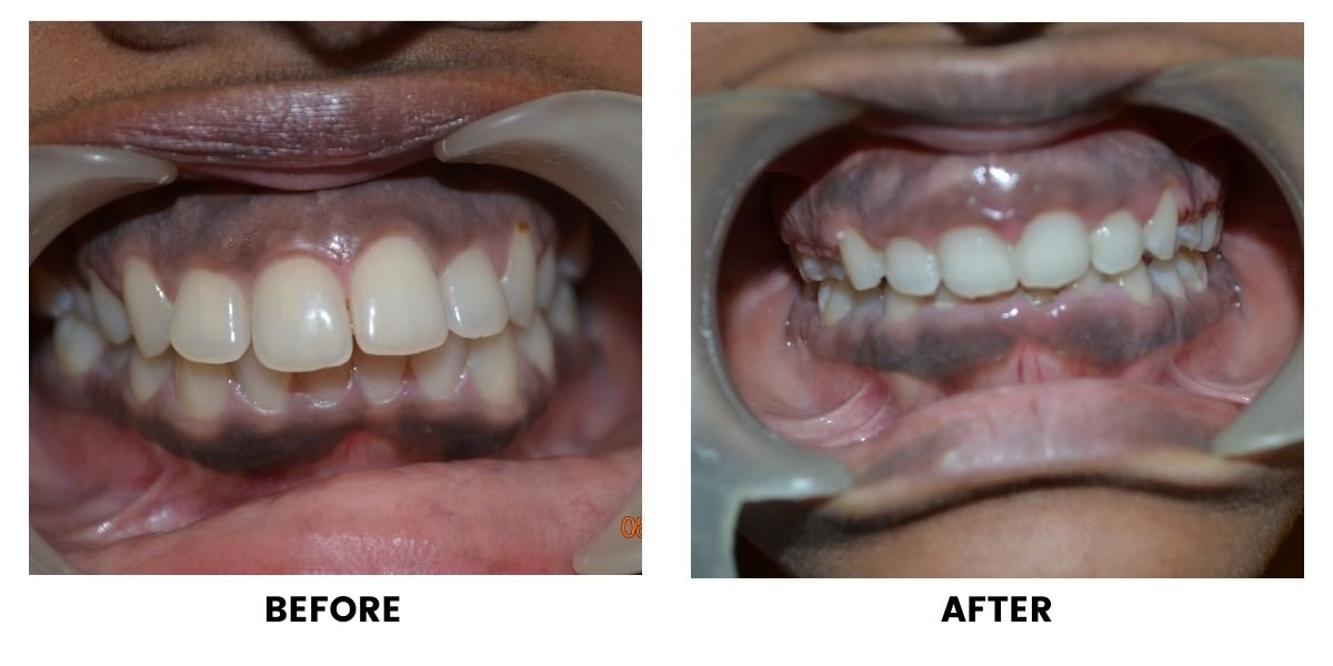 Before and after orthodontic treatment: plate 14 of 53 from the practice’s own record, the patient before treatment on the left and after treatment on the right.