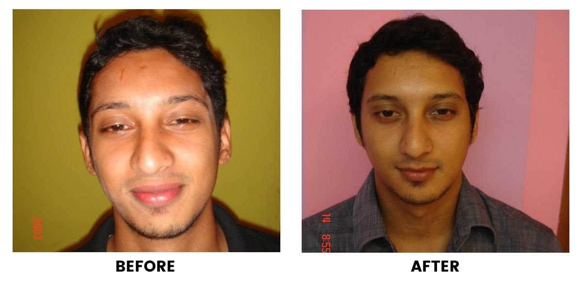 Before and after orthodontic treatment: plate 17 of 53 from the practice’s own record, the patient before treatment on the left and after treatment on the right.