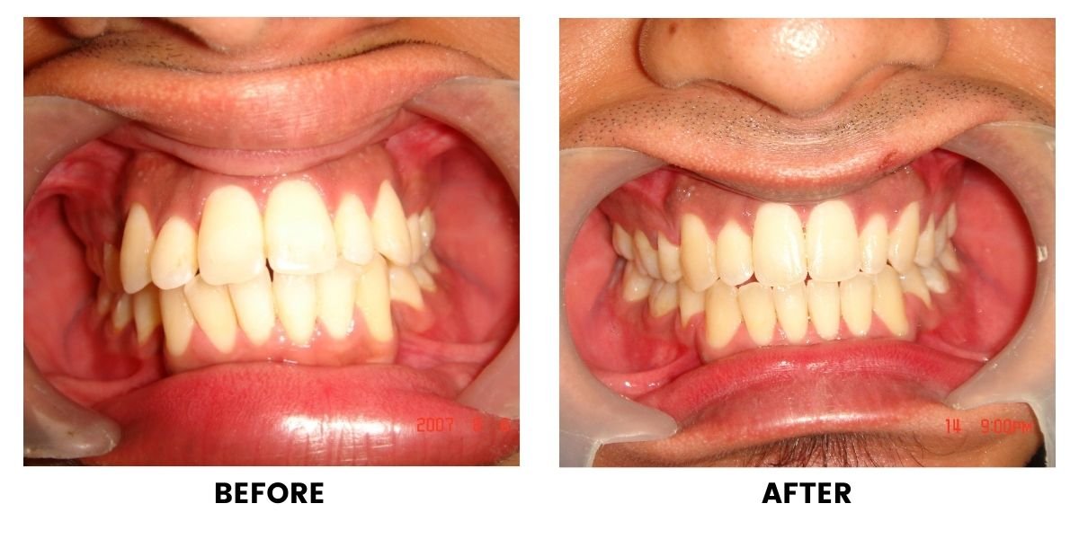 Before and after orthodontic treatment: plate 18 of 53 from the practice’s own record, the patient before treatment on the left and after treatment on the right.