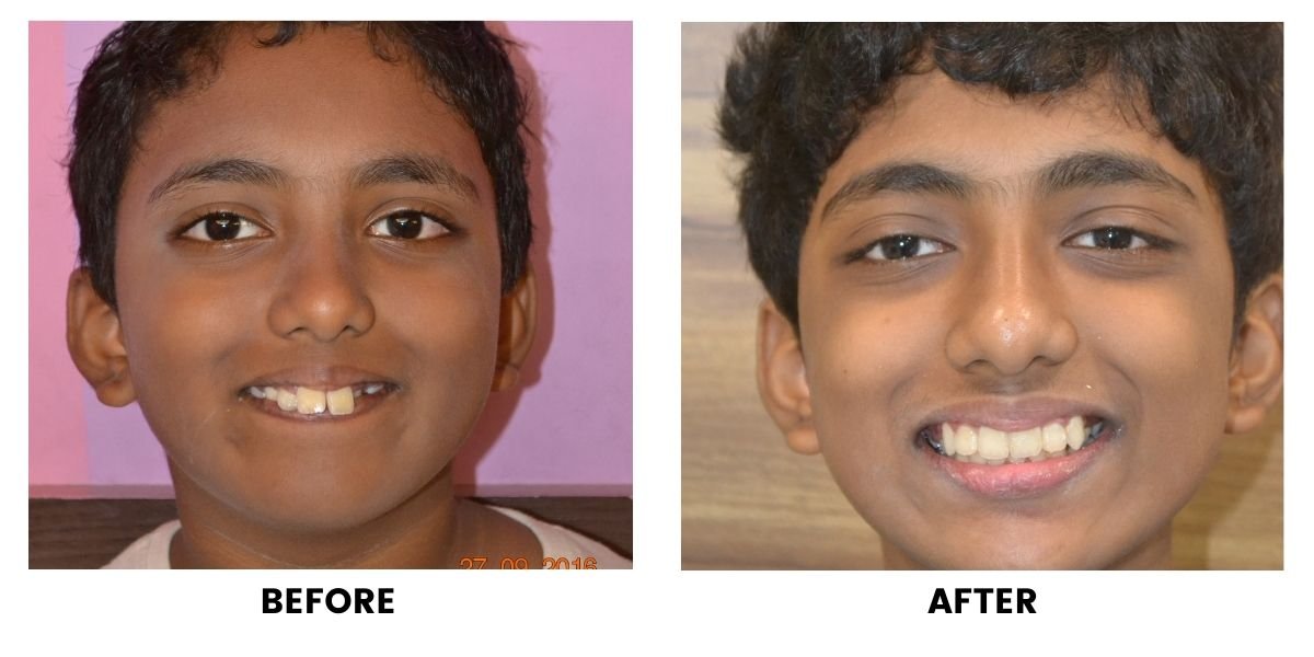 Before and after orthodontic treatment: plate 20 of 53 from the practice’s own record, the patient before treatment on the left and after treatment on the right.