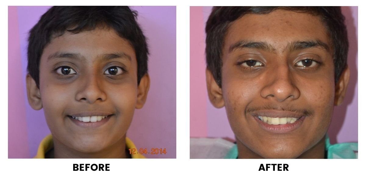 Before and after orthodontic treatment: plate 22 of 53 from the practice’s own record, the patient before treatment on the left and after treatment on the right.