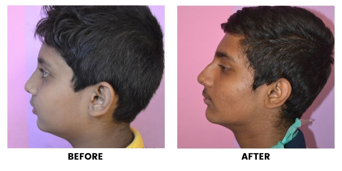Before and after orthodontic treatment: plate 23 of 53 from the practice’s own record, the patient before treatment on the left and after treatment on the right.