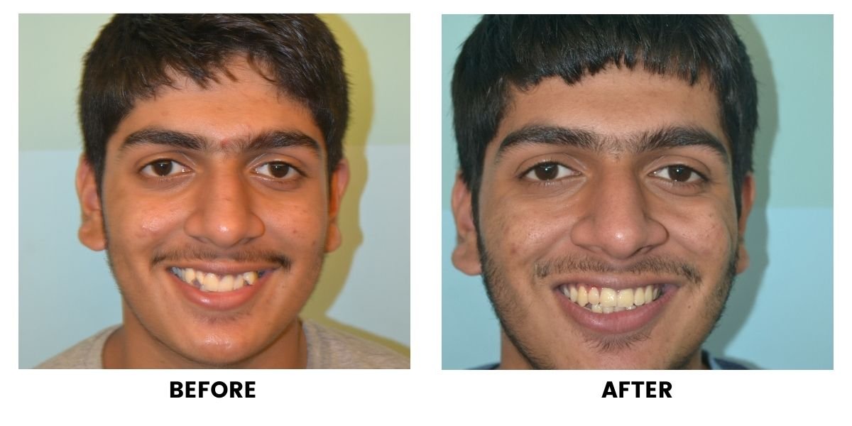 Before and after orthodontic treatment: plate 24 of 53 from the practice’s own record, the patient before treatment on the left and after treatment on the right.