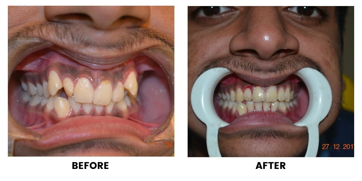 Before and after orthodontic treatment: plate 25 of 53 from the practice’s own record, the patient before treatment on the left and after treatment on the right.