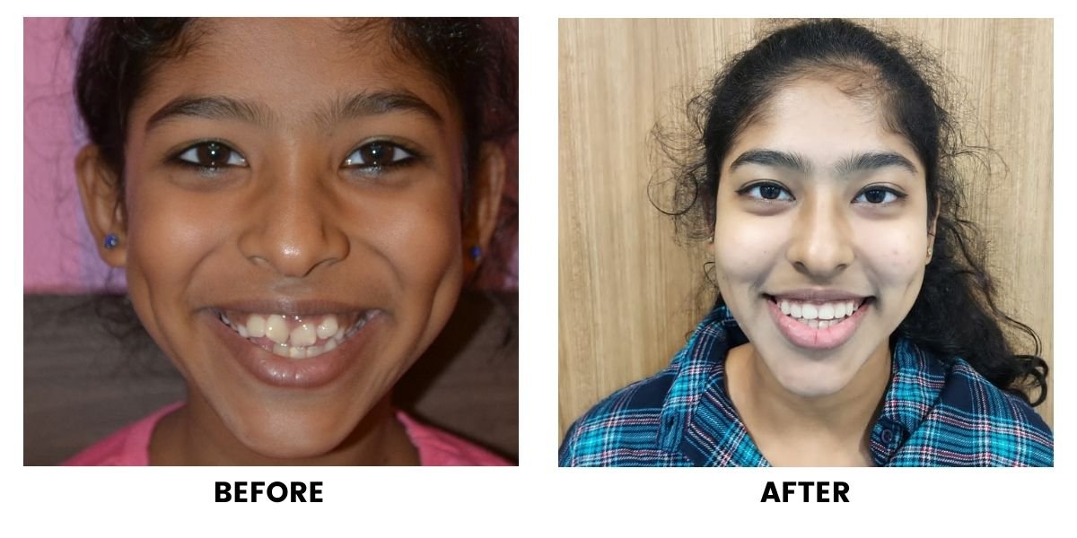 Before and after orthodontic treatment: plate 26 of 53 from the practice’s own record, the patient before treatment on the left and after treatment on the right.