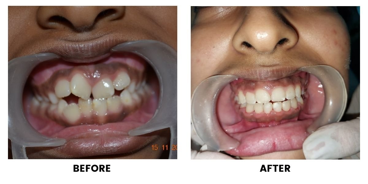 Before and after orthodontic treatment: plate 28 of 53 from the practice’s own record, the patient before treatment on the left and after treatment on the right.