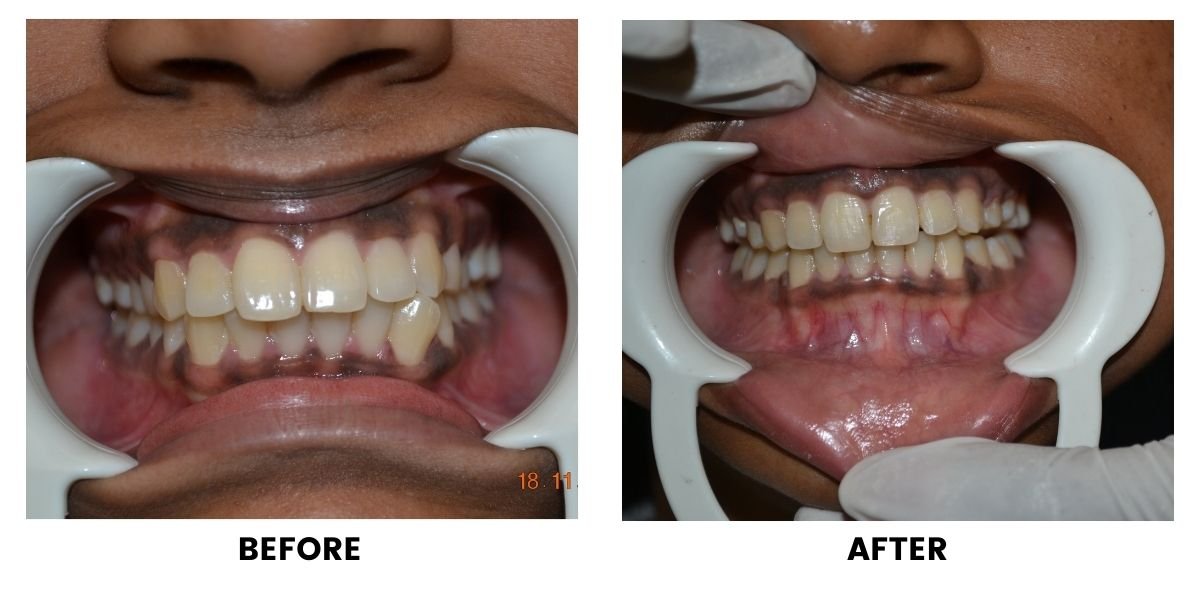 Before and after orthodontic treatment: plate 30 of 53 from the practice’s own record, the patient before treatment on the left and after treatment on the right.