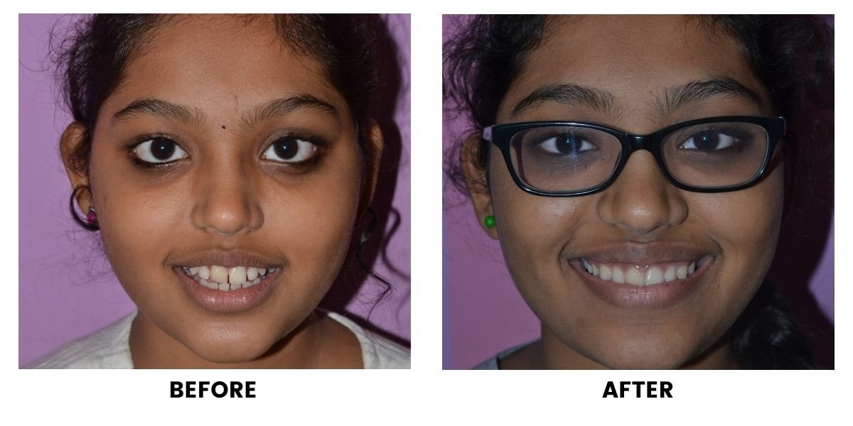 Before and after orthodontic treatment: plate 31 of 53 from the practice’s own record, the patient before treatment on the left and after treatment on the right.