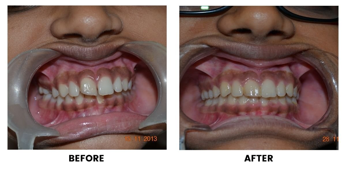 Before and after orthodontic treatment: plate 32 of 53 from the practice’s own record, the patient before treatment on the left and after treatment on the right.
