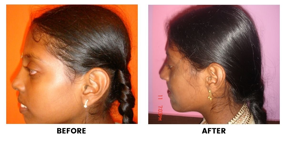 Before and after orthodontic treatment: plate 33 of 53 from the practice’s own record, the patient before treatment on the left and after treatment on the right.