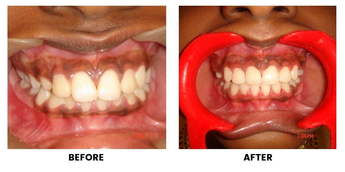 Before and after orthodontic treatment: plate 34 of 53 from the practice’s own record, the patient before treatment on the left and after treatment on the right.