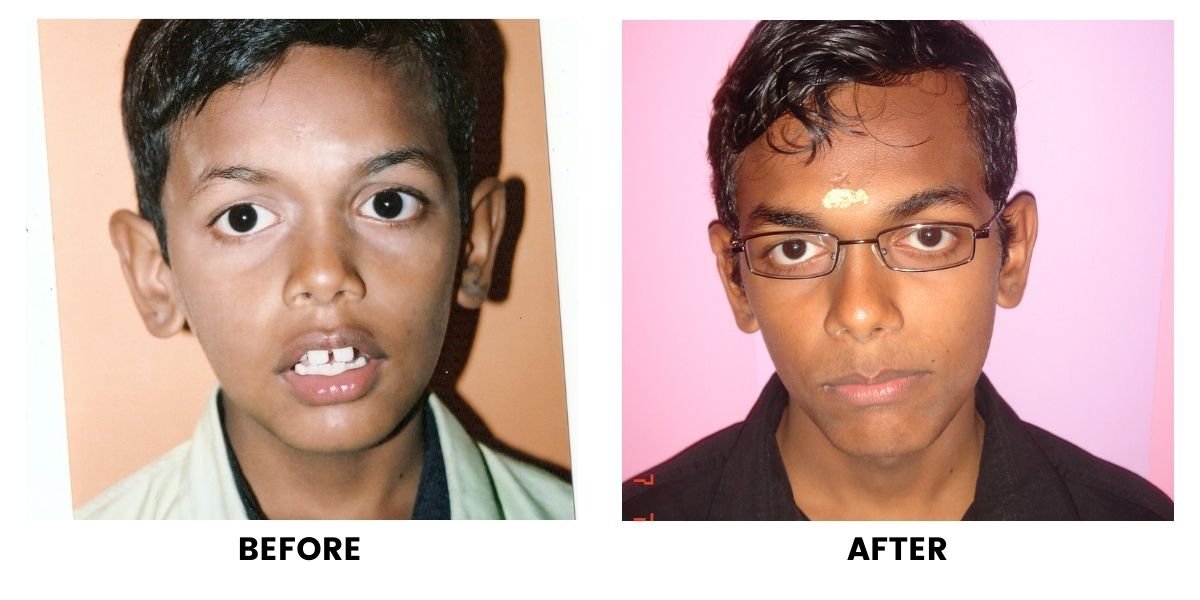 Before and after orthodontic treatment: plate 35 of 53 from the practice’s own record, the patient before treatment on the left and after treatment on the right.