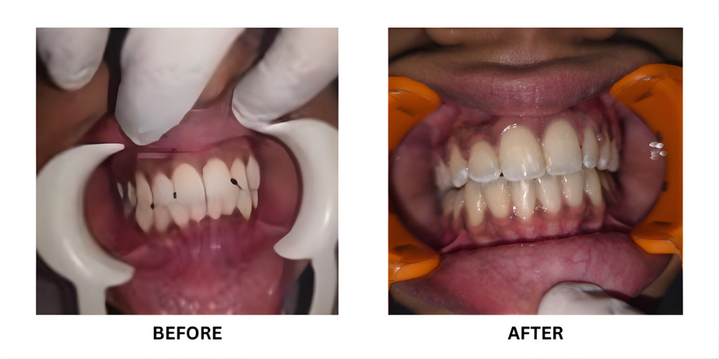Before and after orthodontic treatment: plate 42 of 53 from the practice’s own record, the patient before treatment on the left and after treatment on the right.