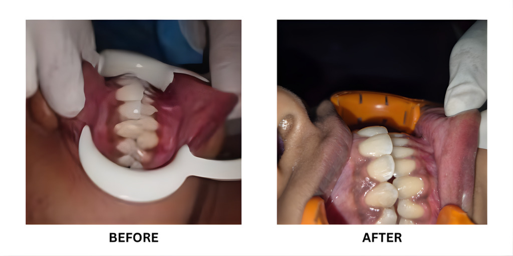 Before and after orthodontic treatment: plate 43 of 53 from the practice’s own record, the patient before treatment on the left and after treatment on the right.