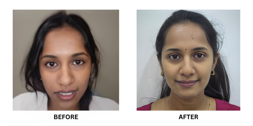 Before and after orthodontic treatment: plate 44 of 53 from the practice’s own record, the patient before treatment on the left and after treatment on the right.