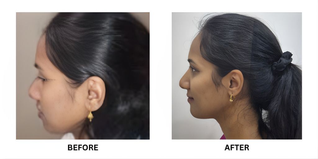 Before and after orthodontic treatment: plate 46 of 53 from the practice’s own record, the patient before treatment on the left and after treatment on the right.