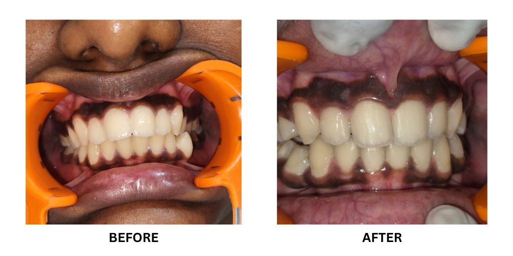 Before and after orthodontic treatment: plate 47 of 53 from the practice’s own record, the patient before treatment on the left and after treatment on the right.
