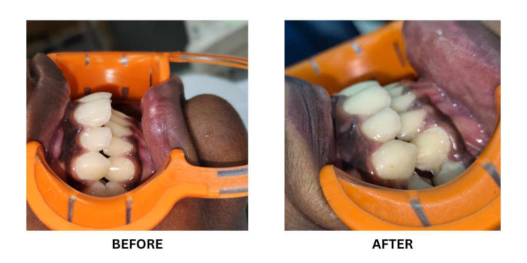 Before and after orthodontic treatment: plate 48 of 53 from the practice’s own record, the patient before treatment on the left and after treatment on the right.