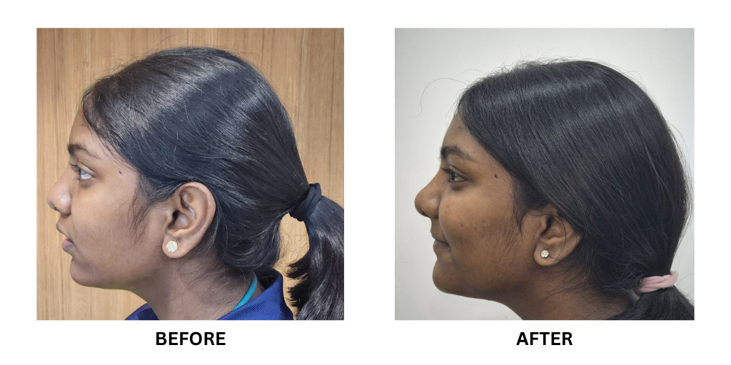 Before and after orthodontic treatment: plate 50 of 53 from the practice’s own record, the patient before treatment on the left and after treatment on the right.
