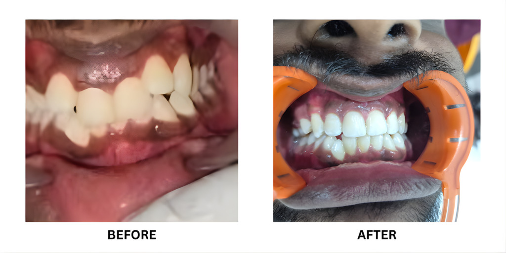 Before and after orthodontic treatment: plate 52 of 53 from the practice’s own record, the patient before treatment on the left and after treatment on the right.