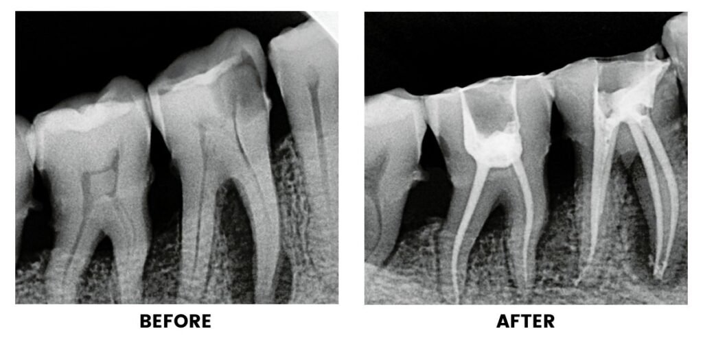 Before and after root canal treatment, shown on radiographs: the untreated tooth on the left and the filled root canals on the right.