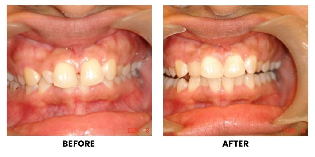 Before and after a smile makeover: plate 3 of 4 from the practice’s own record, the patient before treatment on the left and after treatment on the right.