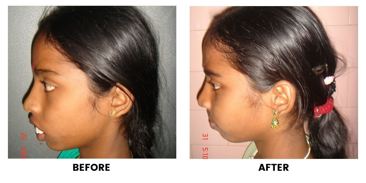 Before and after jaw surgery: plate 1 of 3 from the practice’s own record, the patient before treatment on the left and after treatment on the right.