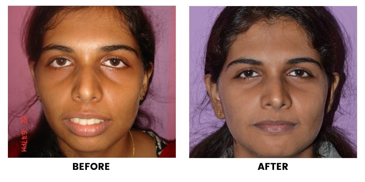 Before and after jaw surgery: plate 2 of 3 from the practice’s own record, the patient before treatment on the left and after treatment on the right.